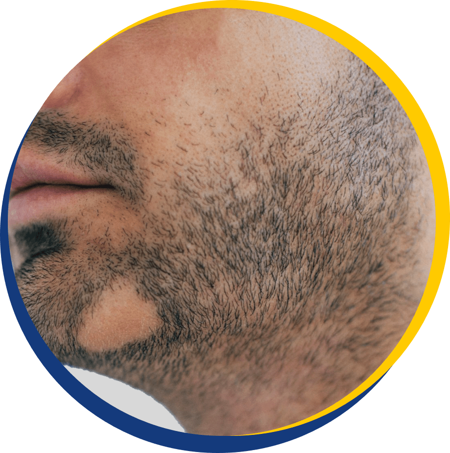 Facial Hair (Beard) Loss - The Knudsen Clinic