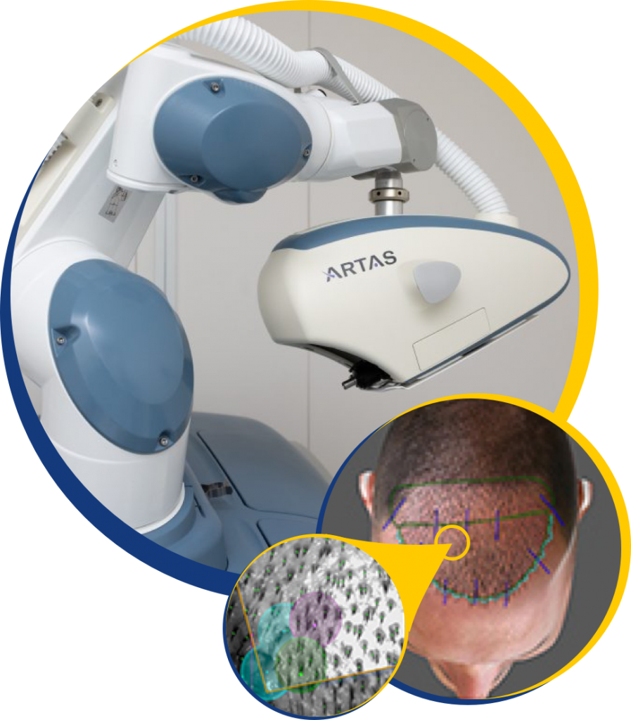 ARTAS Hair Transplant Robot - The Knudsen Clinic