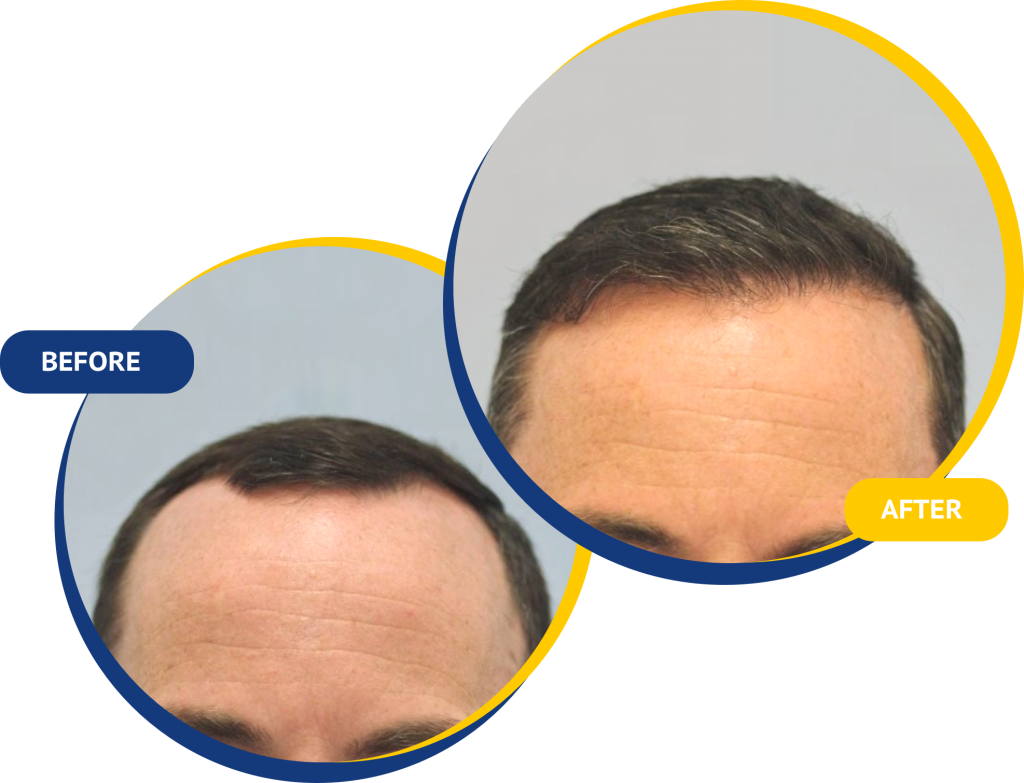 Pros & Cons of Fue Beard Transplant | Hair Sure