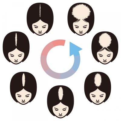 Female pattern hair loss set. Stages of baldness in women.